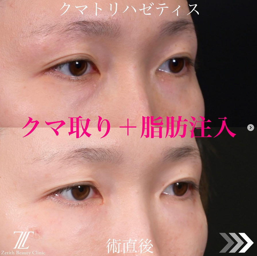 《術直後》上木原医師によるクマ取り＋脂肪注入 หลัง 