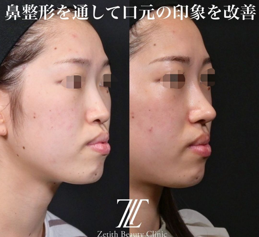 鉄医師による鼻のフルコースの施術前／施術後1ヶ月 施術後 