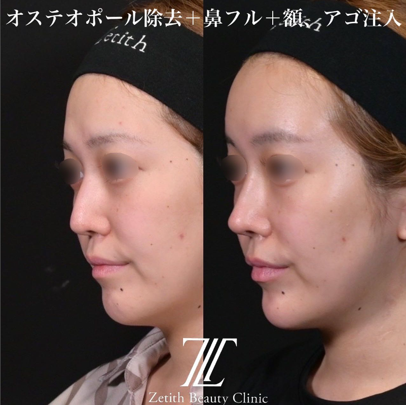 鉄医師による鼻のフルコースの施術前／施術後1ヶ月 施術後 