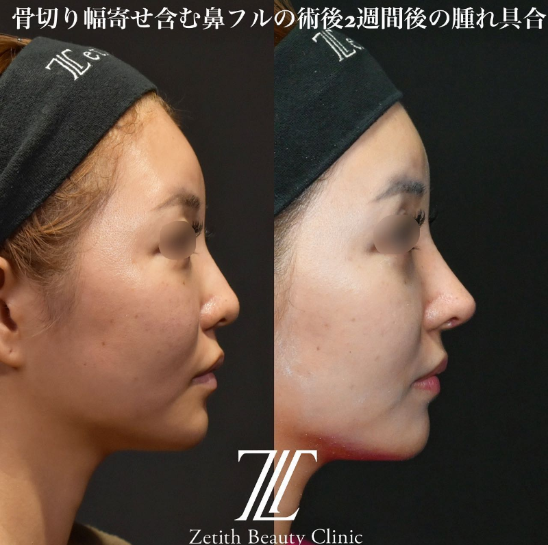 鉄医師による鼻のフルコースの施術前／施術後2週間 Sau 