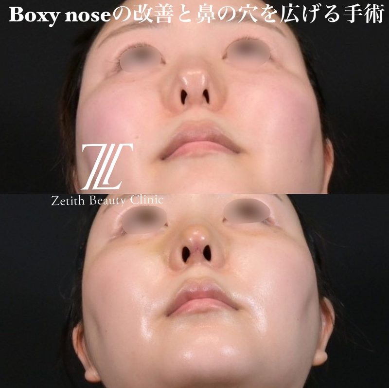 鉄医師による鼻のフルコースの施術前／施術後1週間 施術後 