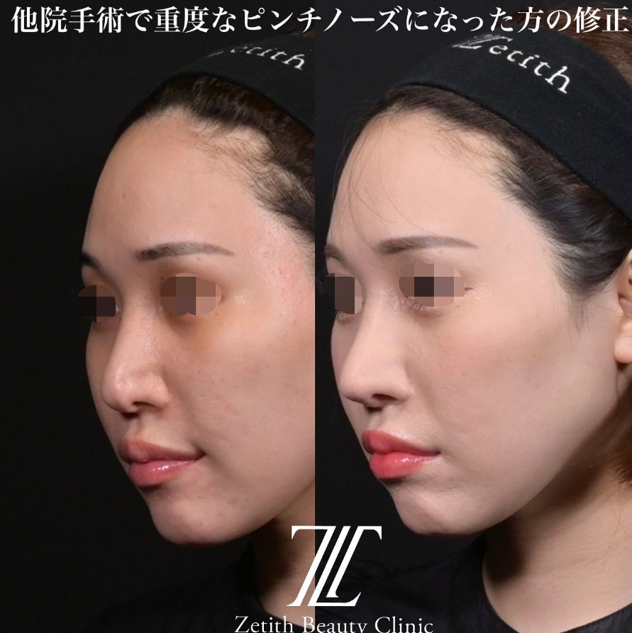 鉄医師による鼻のフルコースの施術前／施術後1ヶ月 施術後 