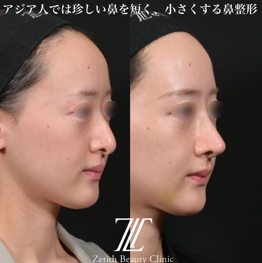 鉄医師による鼻のフルコースの施術前／施術後2週間 施術後 