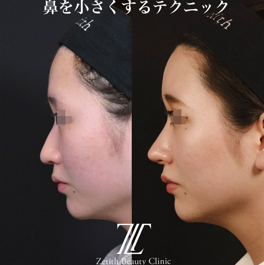 鉄医師による鼻のフルコースの施術前／施術後3ヶ月 施術後 