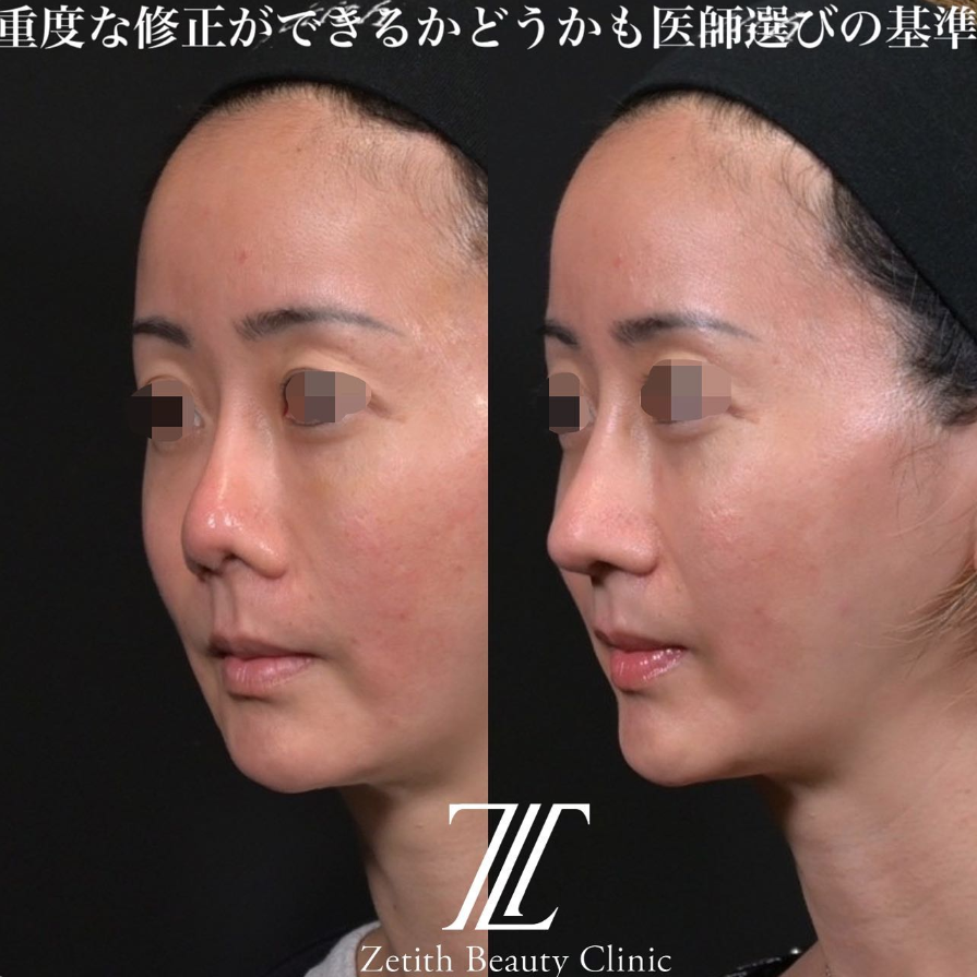 鉄医師による鼻のフルコースの施術前／施術後1ヶ月 Дараа 