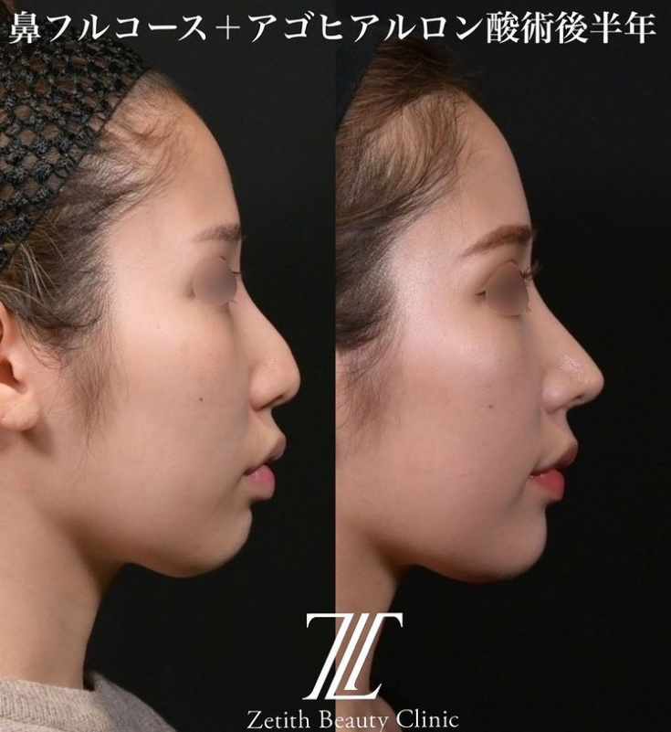 鉄医師による鼻のフルコースの施術前／施術後6ヶ月