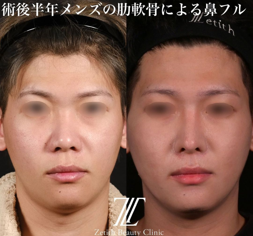 鉄医師による鼻のフルコースの施術前／施術後6ヶ月 施術後 
