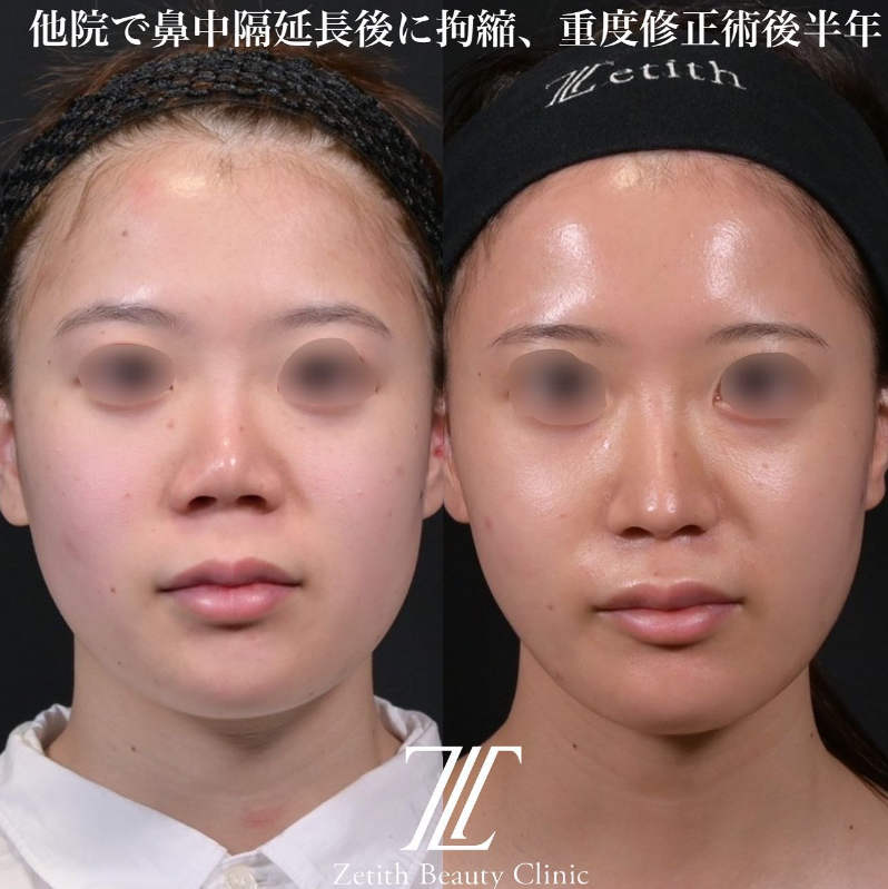 鉄医師による鼻のフルコースの施術前／施術後6ヶ月