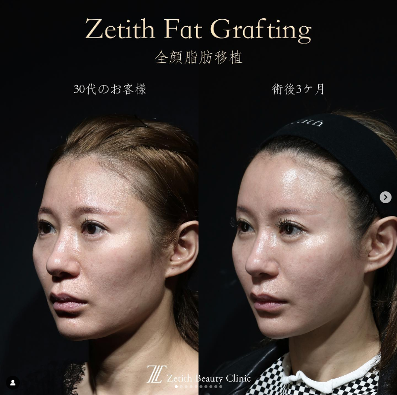 《術後3ヶ月》王医師による糸リフト＋脂肪注入＋クマ取り After 