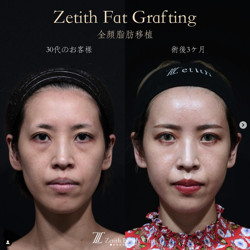 《術後3ヶ月》王医師による糸リフト＋クマ取り＋脂肪注入