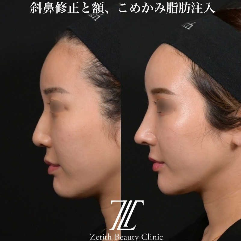 鉄医師による鼻のフルコースの施術前／施術後
