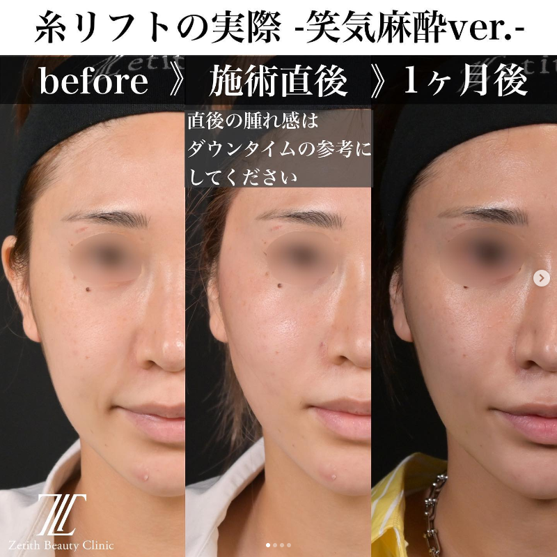 《術後1ヶ月》新井医師による糸リフト