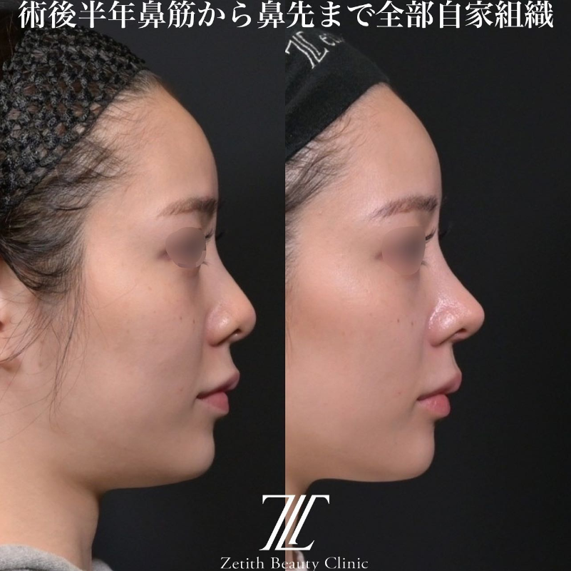 鉄医師による鼻のフルコースの施術前／施術後6ヶ月