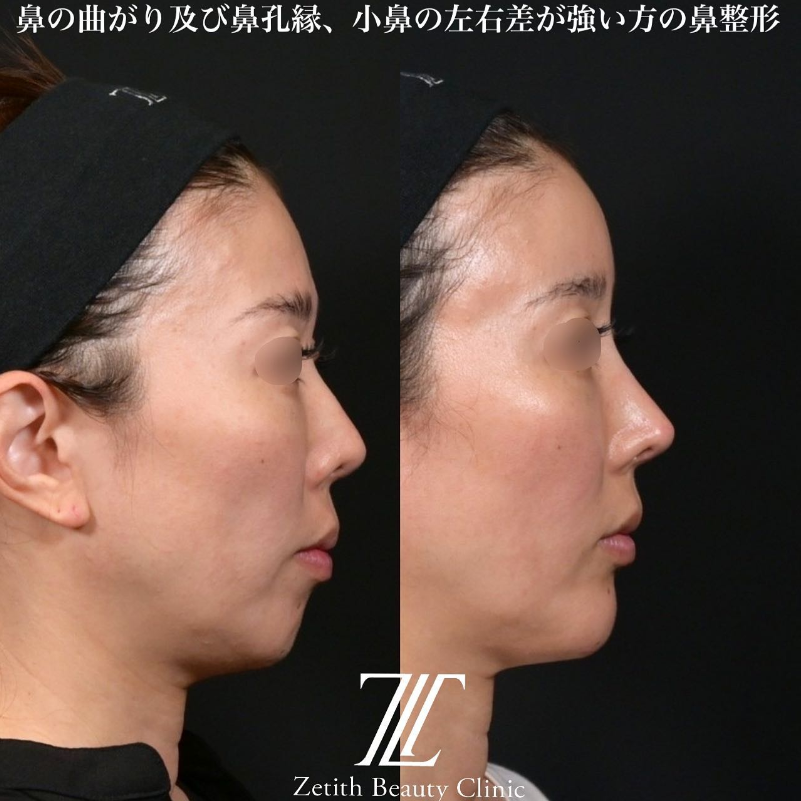 鉄医師による鼻のフルコースの施術前／施術後1ヶ月