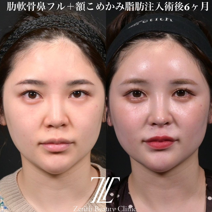 鉄医師による鼻のフルコースの施術前／施術後6ヶ月