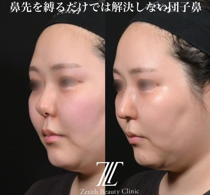 鉄医師による鼻フルコースの施術前／施術後1ヶ月