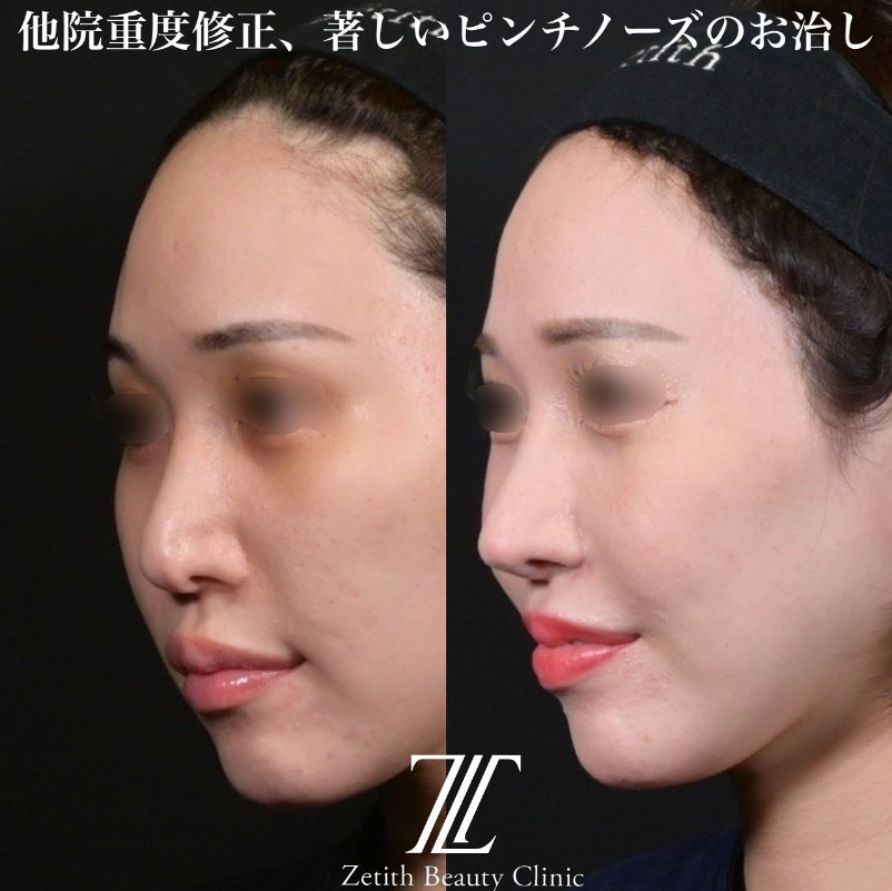 鉄医師による鼻のフルコースの施術前／施術後3ヶ月 施術後 