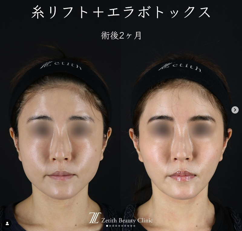 《術後2ヶ月》王医師による糸リフト