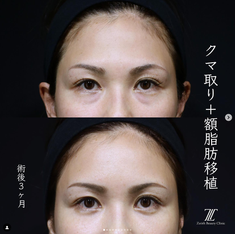 《術後3ヶ月》王医師によるクマ取り