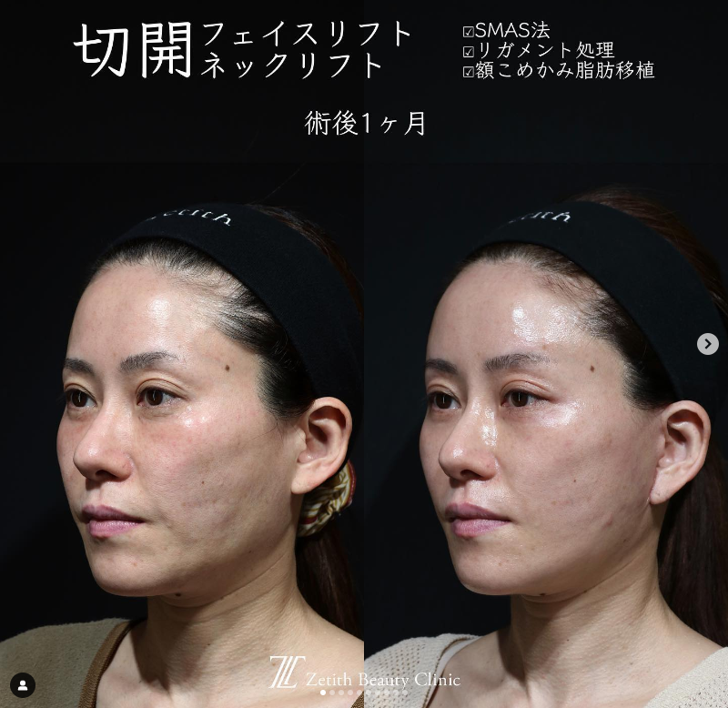 症例写真