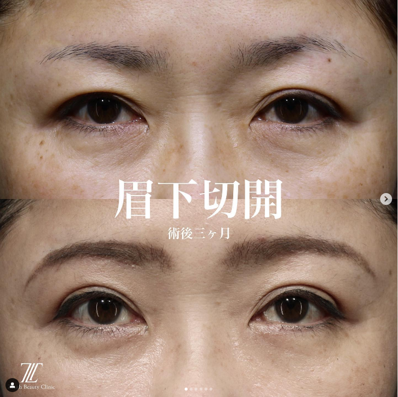 《術後3ヶ月》王医師による眉下切開