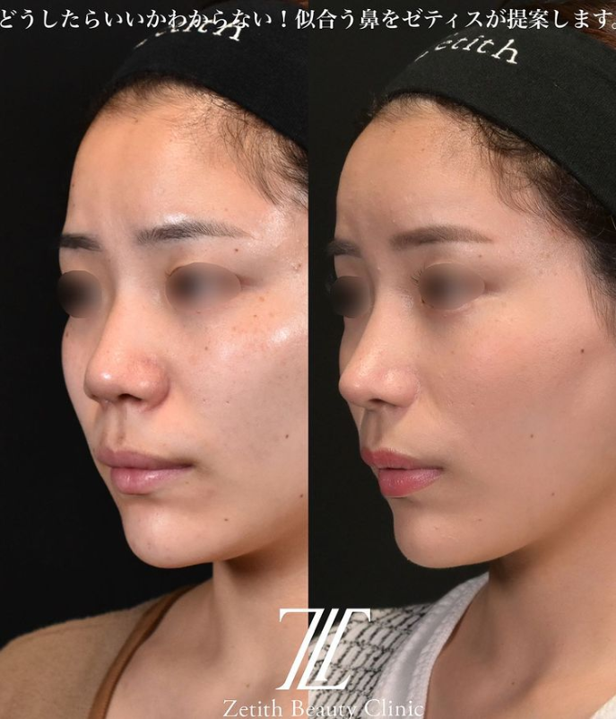 鉄医師による鼻のフルコースの施術前／施術後3ヶ月