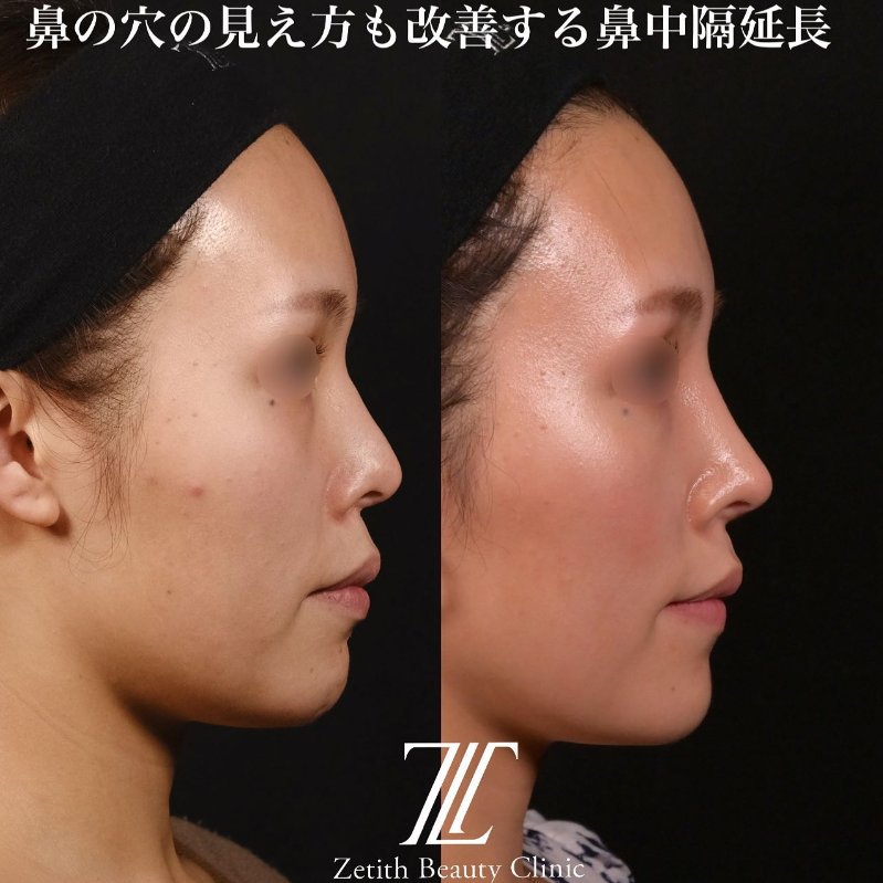 鉄医師による鼻のフルコースの施術前／施術後3ヶ月