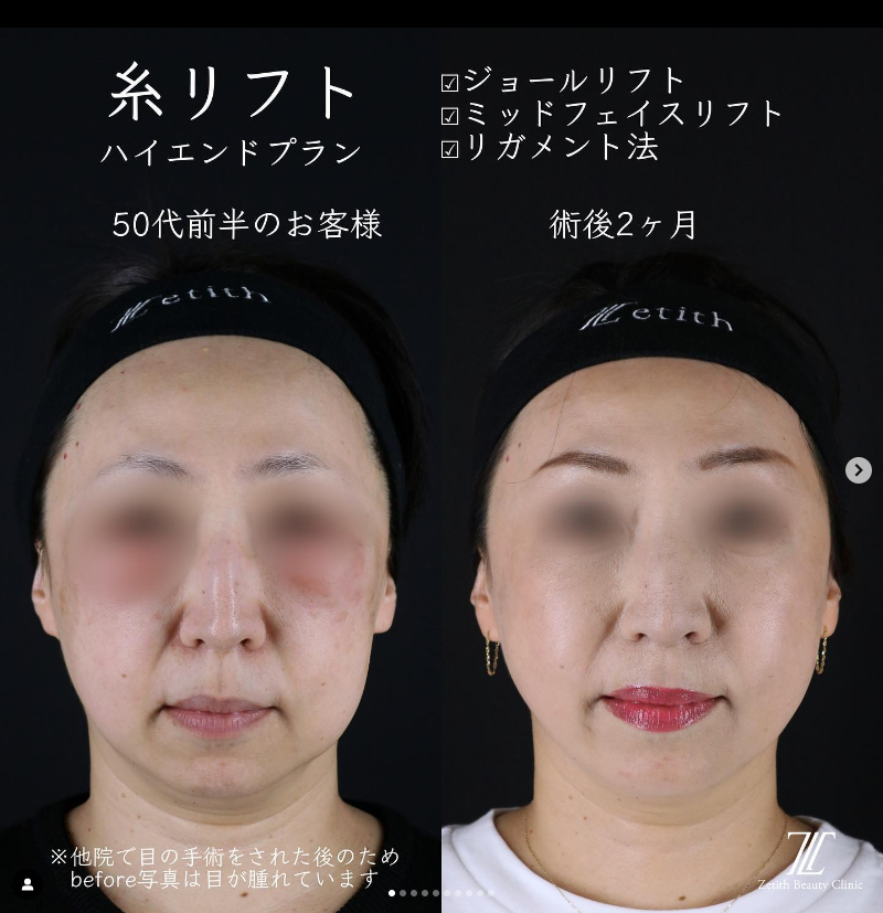 《術後2ヶ月》王医師による糸リフト