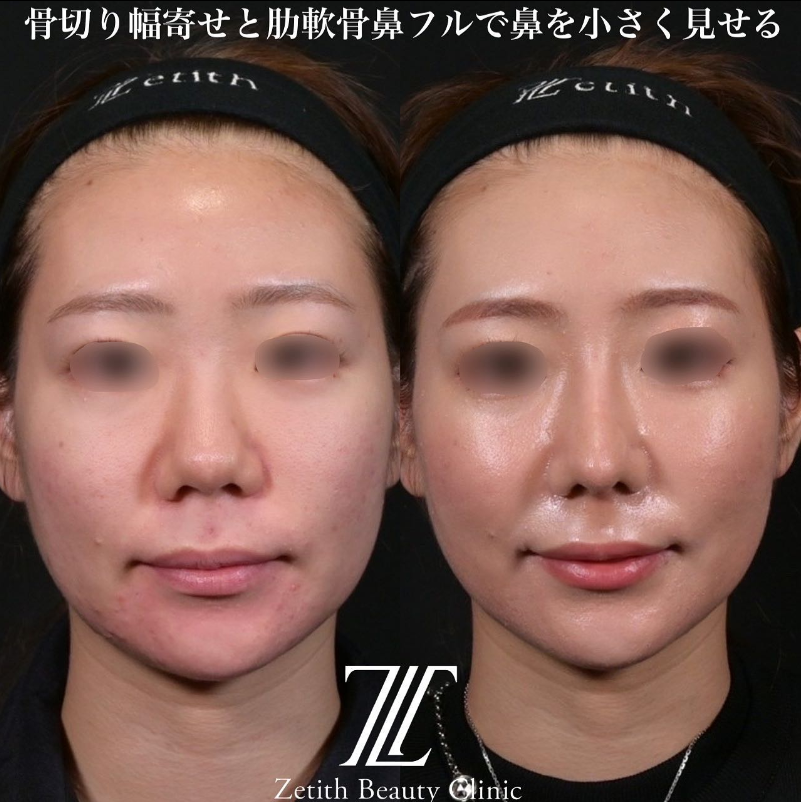 鉄医師による鼻のフルコースの施術前／施術後1ヶ月
