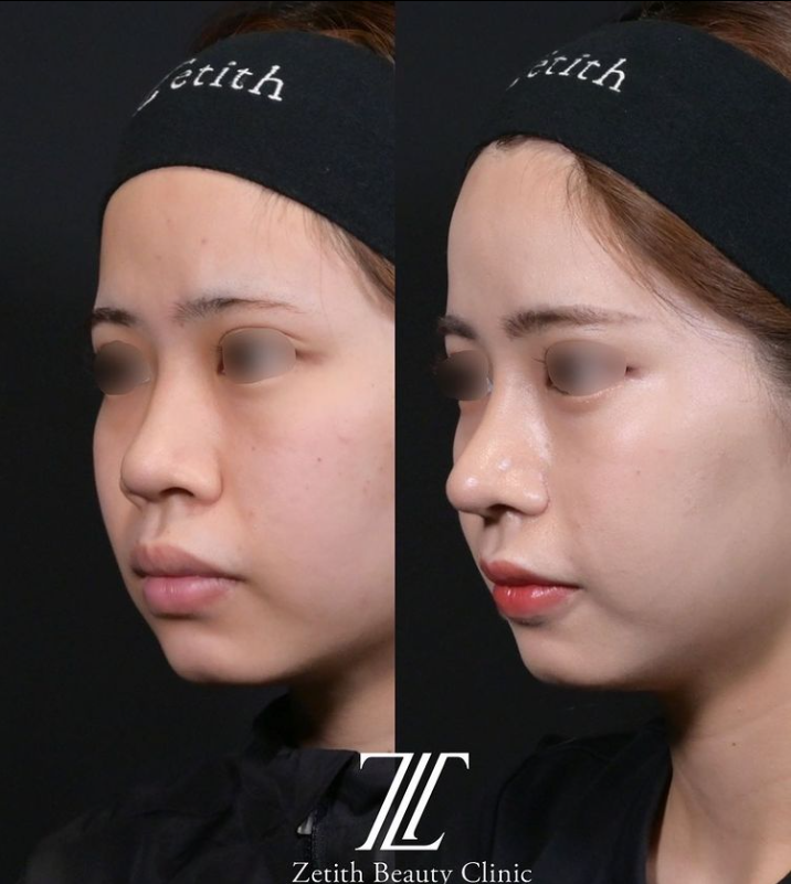 鉄医師による鼻のフルコースの施術前／施術後1ヶ月 术后 