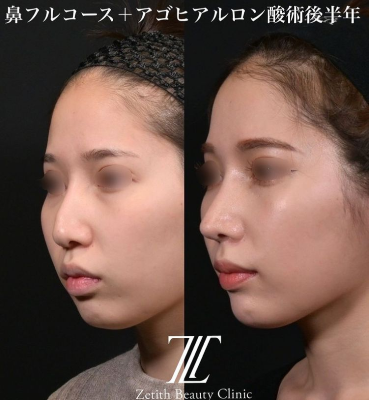 鉄医師による鼻のフルコースの施術前／施術後6ヶ月 施術後 