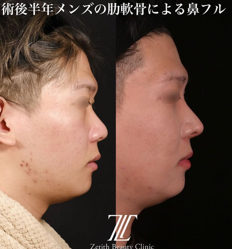 鉄医師による鼻のフルコースの施術前／施術後6ヶ月