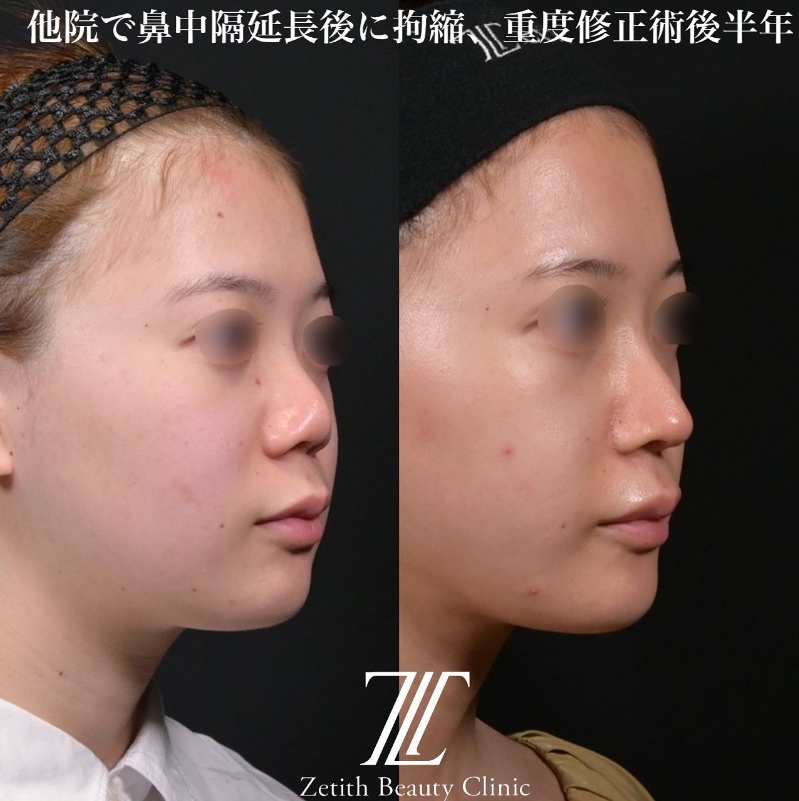 鉄医師による鼻のフルコースの施術前／施術後6ヶ月 术后 