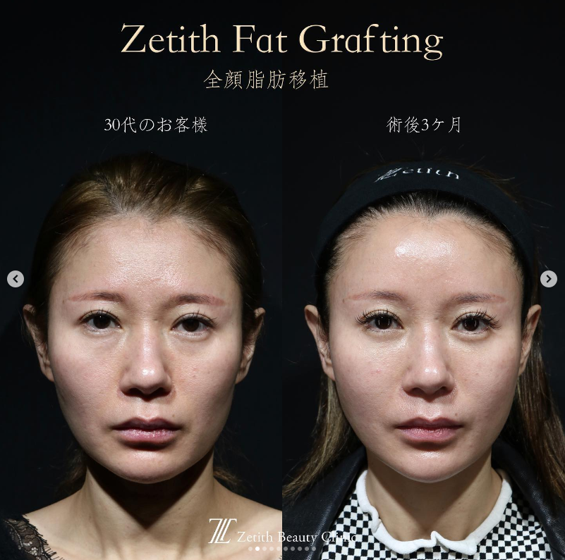 《術後3ヶ月》王医師による糸リフト＋脂肪注入＋クマ取り