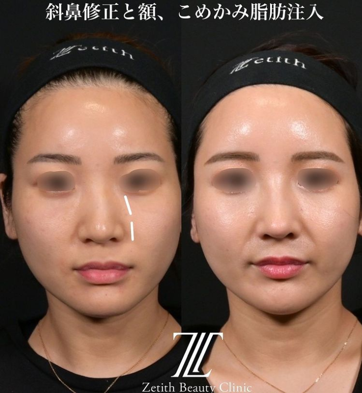 鉄医師による鼻のフルコースの施術前／施術後 术后 