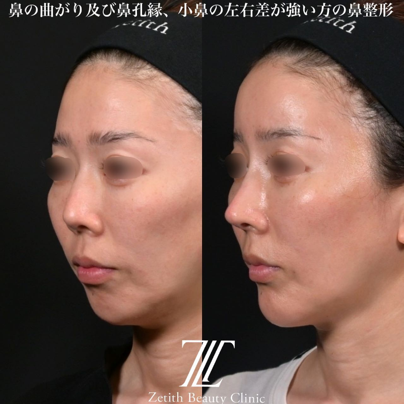 鉄医師による鼻のフルコースの施術前／施術後1ヶ月 施術後 