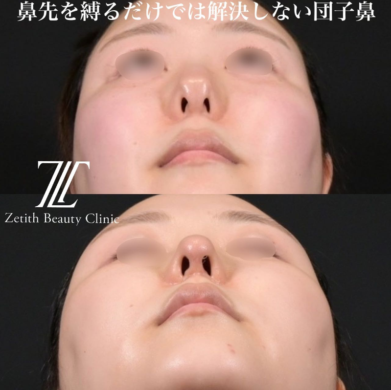 鉄医師による鼻フルコースの施術前／施術後1ヶ月 Sau 
