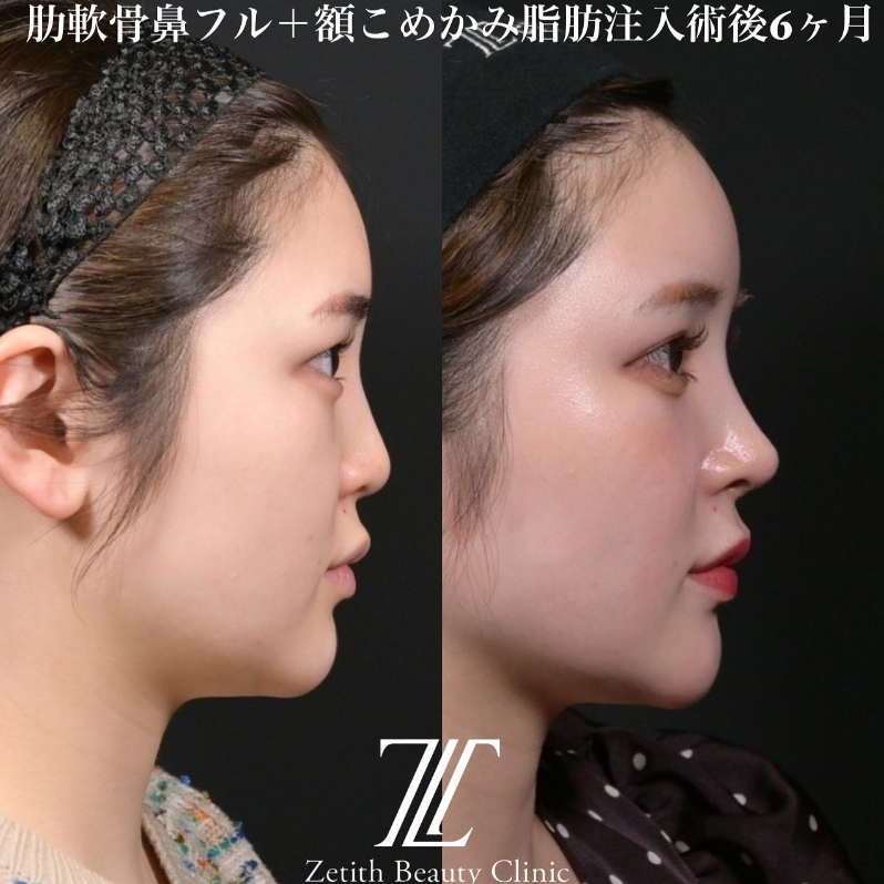 鉄医師による鼻のフルコースの施術前／施術後6ヶ月 术后 