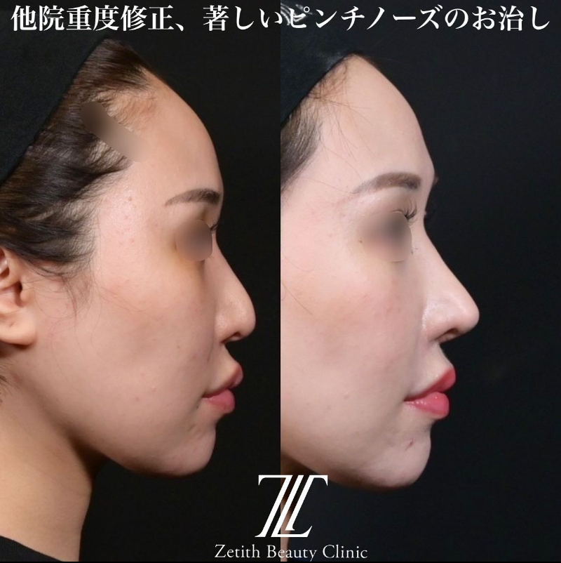 鉄医師による鼻のフルコースの施術前／施術後3ヶ月