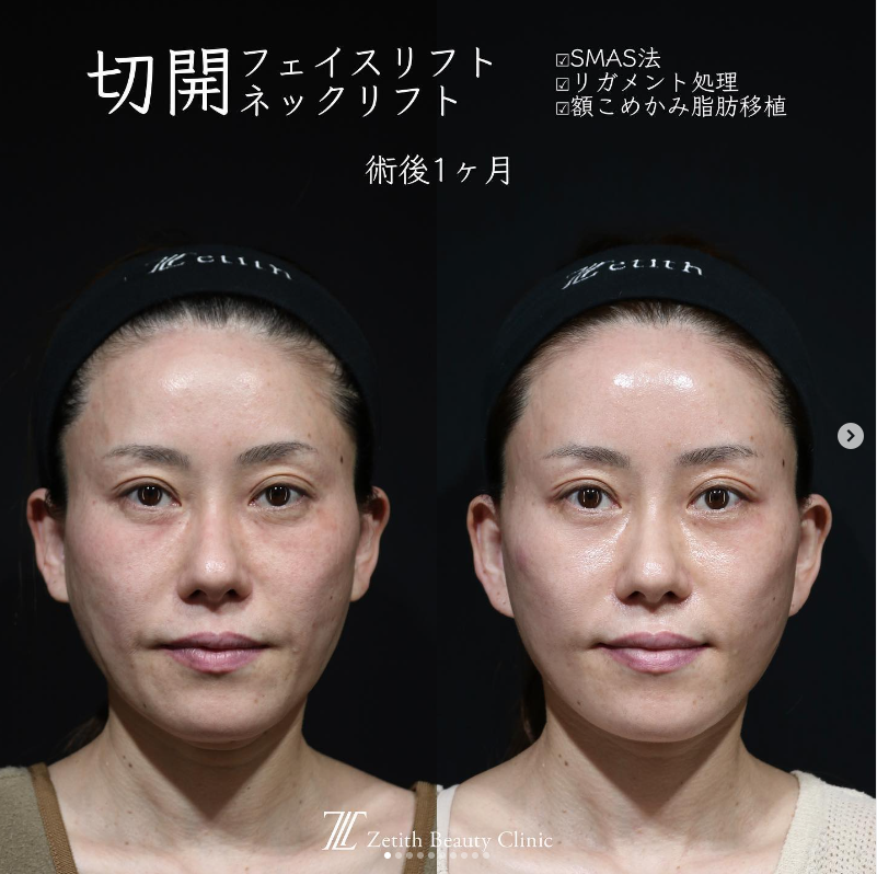 症例写真