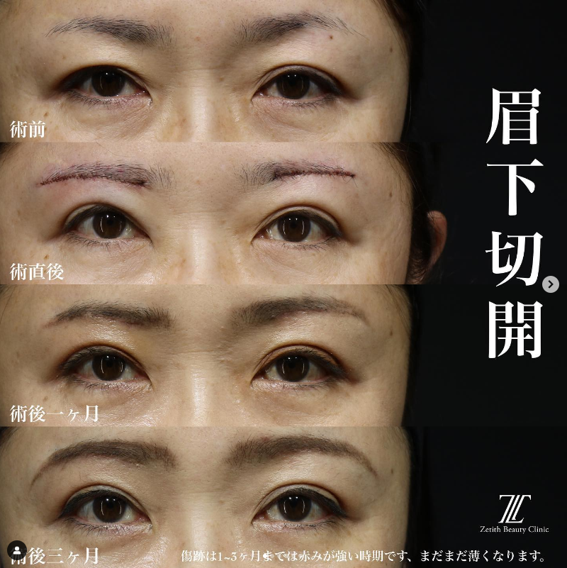 《術後3ヶ月》王医師による眉下切開 Sonra 