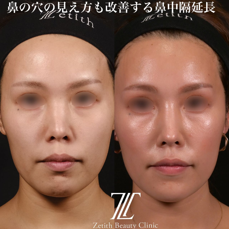 鉄医師による鼻のフルコースの施術前／施術後3ヶ月 施術後 