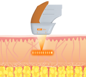 従来のHIFU
