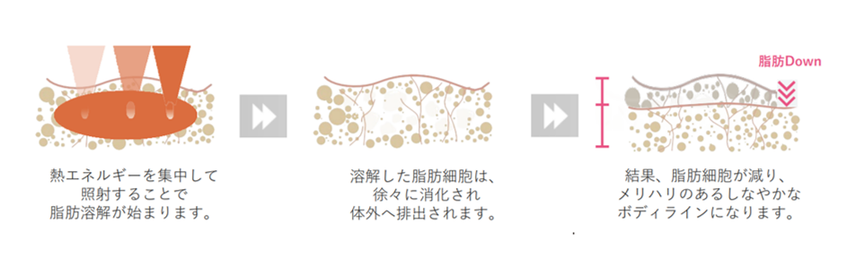 熱を与えて脂肪細胞を溶解します。 脂肪だけに熱がフォーカスするため、痛みはほとんどありません。