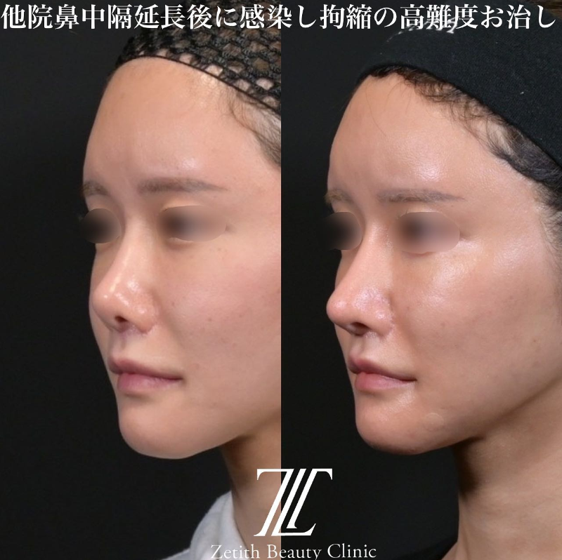 鉄医師による鼻のフルコースの施術前／施術後6ヶ月