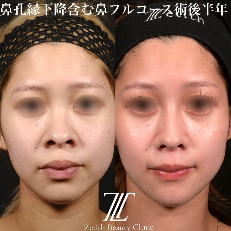 鉄医師による鼻のフルコースの施術前／施術後6ヶ月