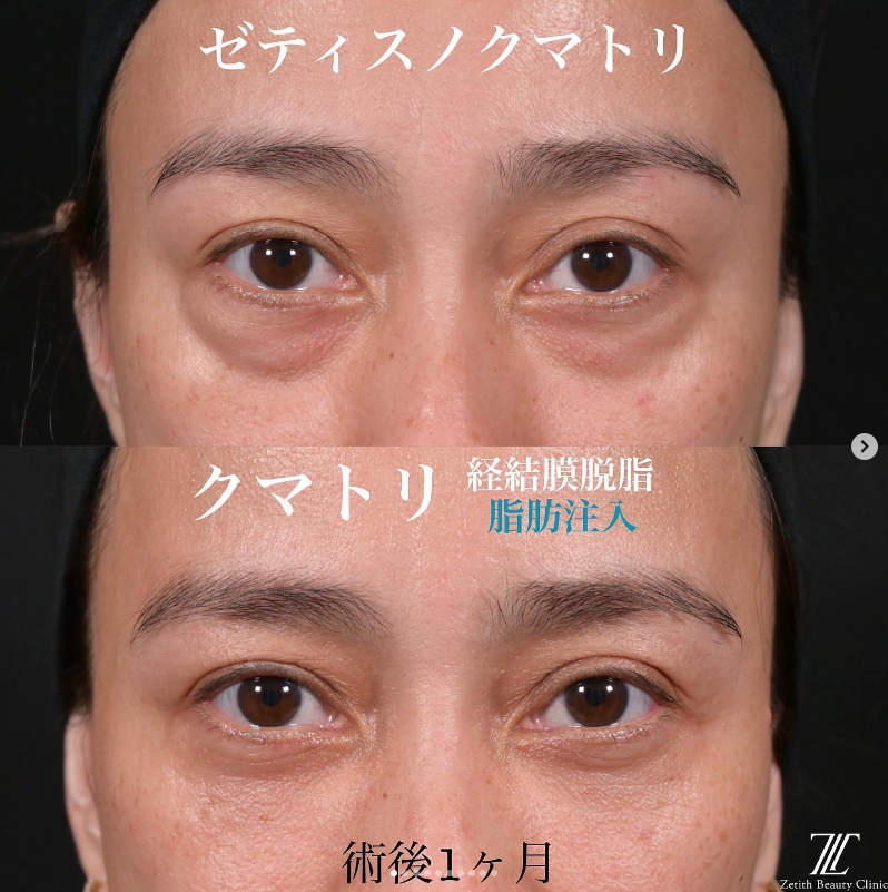 上木原医師によるクマ取り＋脂肪注入の施術前／施術後1ヶ月