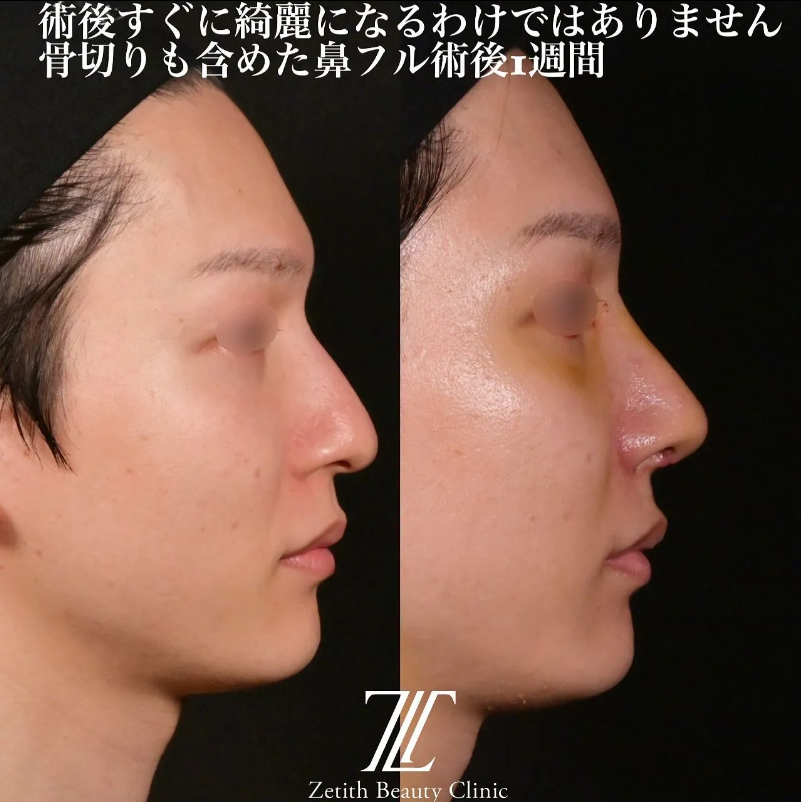 鉄医師による鼻のフルコースの施術前／施術後1週間
