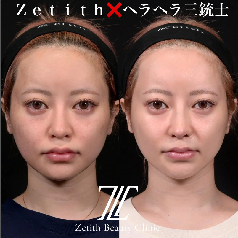 鉄医師による鼻のフルコースの施術前／施術後1ヶ月