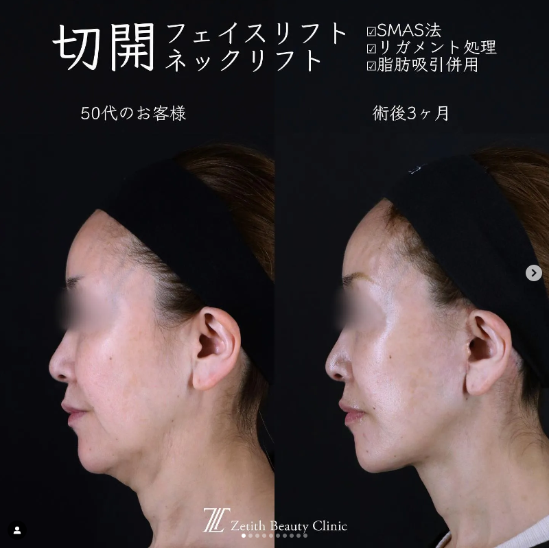 王医師による切開フェイスリフト＋頬アゴ下脂肪吸引の施術前／施術後3ヶ月 Дараа 
